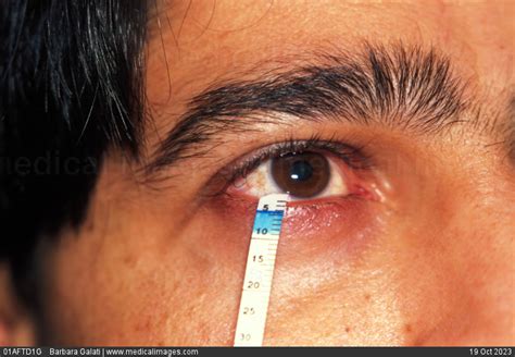 tear production test for sjogren's|sjogren's needle biopsy.